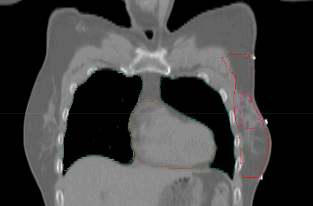 tomodirect with boost CT coronal