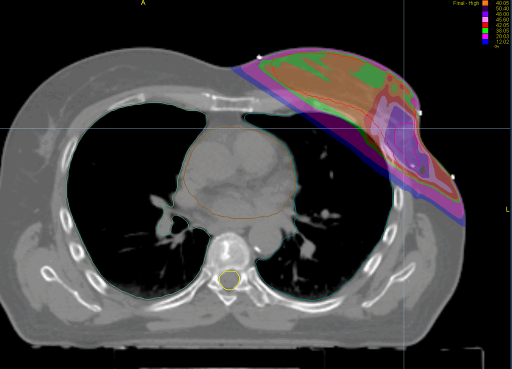 tomodirect with boost dose axial