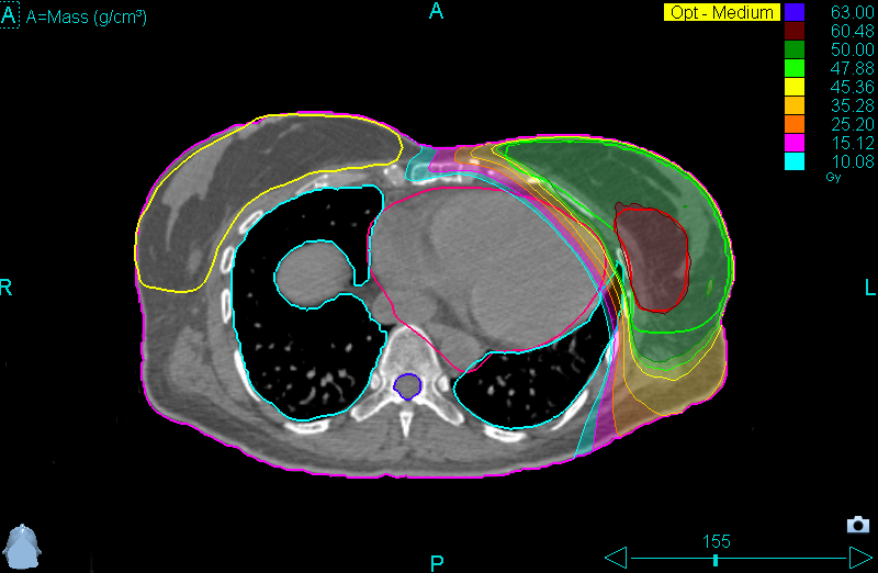 TomoHelical breast axial